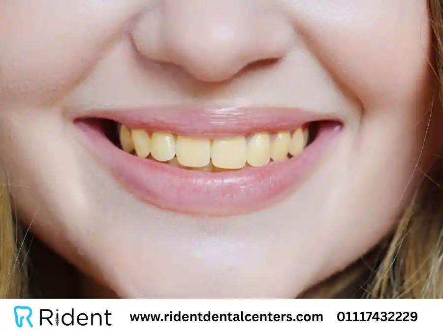 تنظيف الاسنان الصفراء